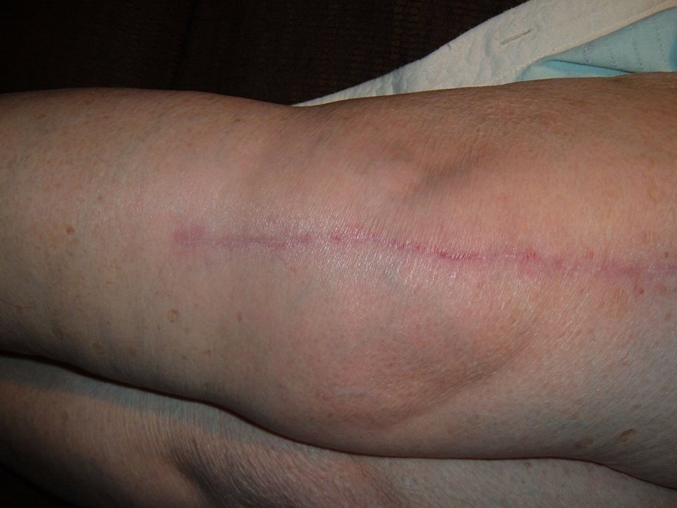 knee-replacement-scar-recovery-timeline-a-photo-gallery